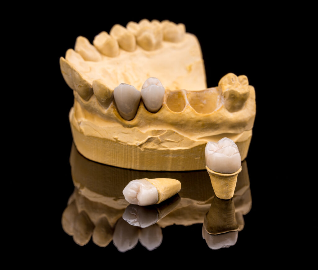 Dental prosthesis