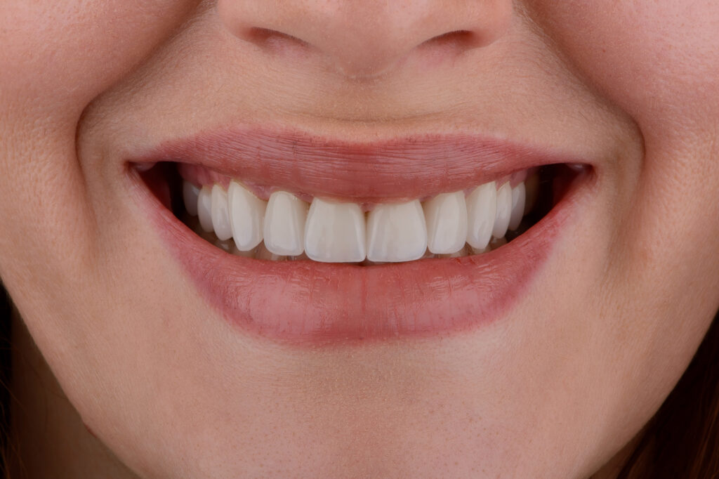 Female smile makeover by dental ceramic veneer, porcelain laminate veneers.