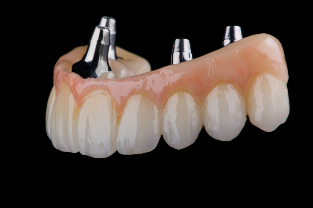 Two stages of making full dental zirkonium prosthesis on titanium bar. Raw before sintering and layered or painted zirkonium.