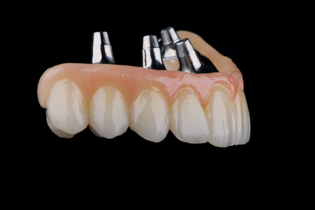 Two stages of making full dental zirkonium prosthesis on titanium bar. Raw before sintering and layered or painted zirkonium.