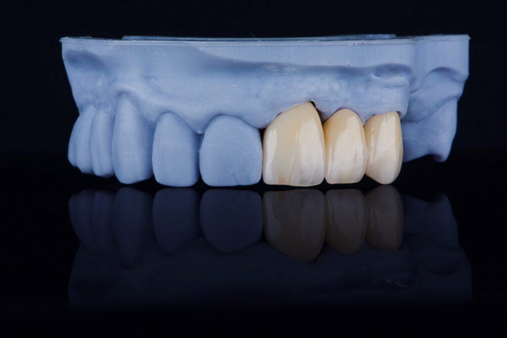 High-quality dental single crowns of upper jaw made of zirconium stylized as an old teeth.