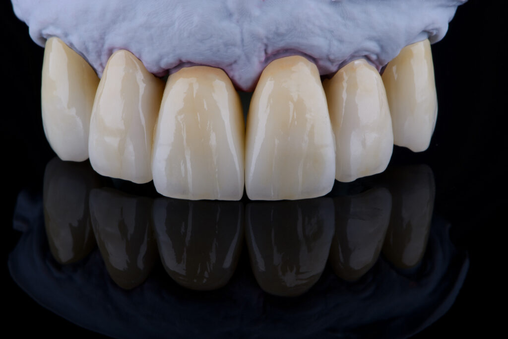 High-quality naturally dental single crowns made of zirconium for fixation to the frontal teeth of upper jaw.