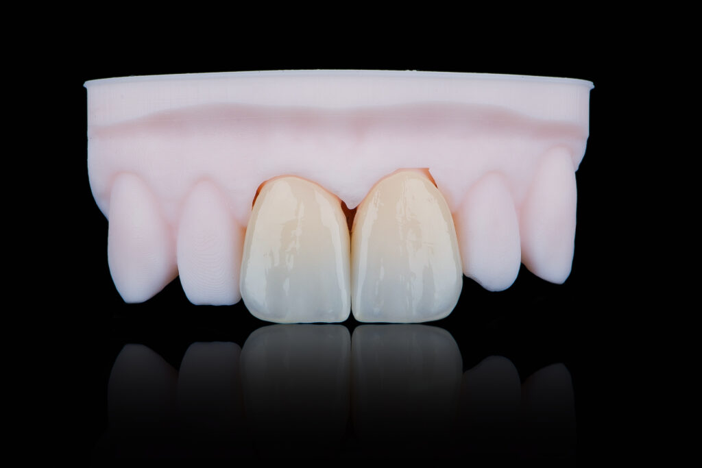 High-quality naturally dental single crowns made of zirconium for fixation to the frontal teeth of upper jaw.