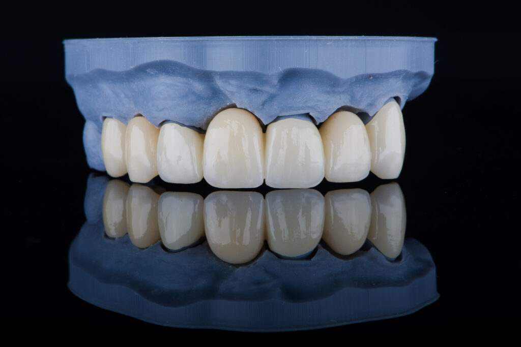 High-quality naturally frontal dental bridge made of zirconium for fixation to upper jaw.